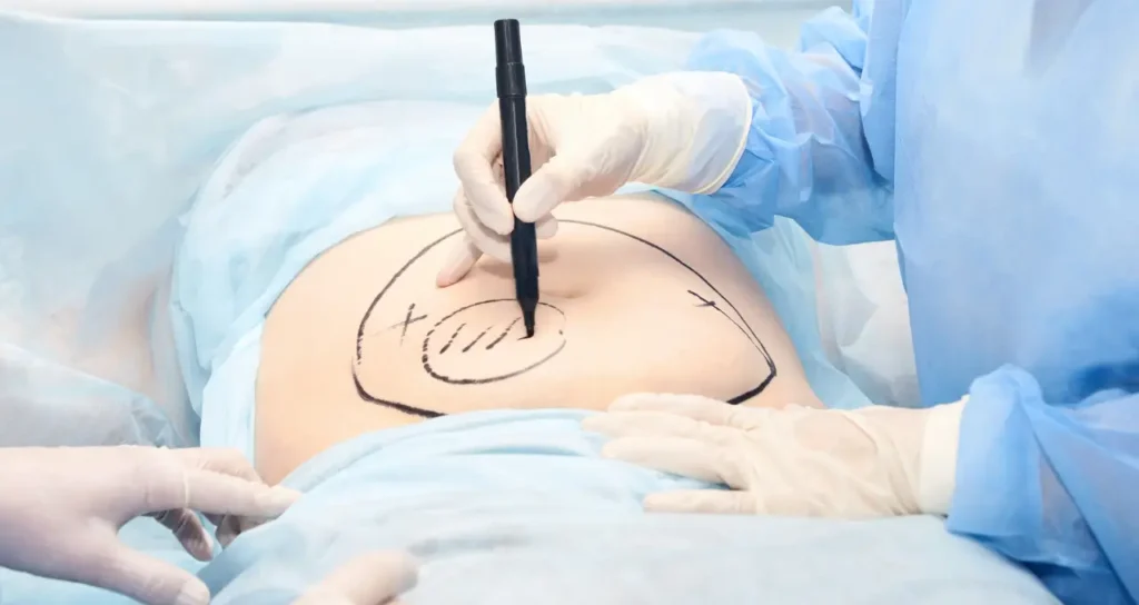 Você Sabia Que Pode Conseguir Lipoaspiração pelo Plano de Saúde Saiba Como em 2024
