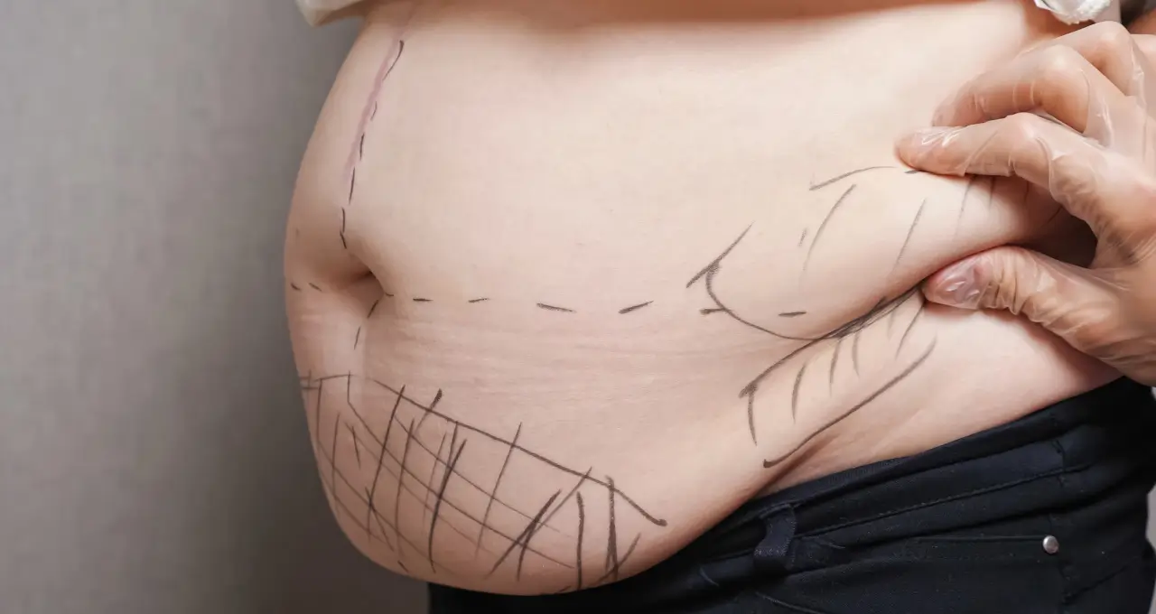 Você Sabia Que Pode Conseguir Lipoaspiração pelo Plano de Saúde? Saiba Como em 2024 1 Você Sabia Que Pode Conseguir Lipoaspiração pelo Plano de Saúde Saiba Como em 2024