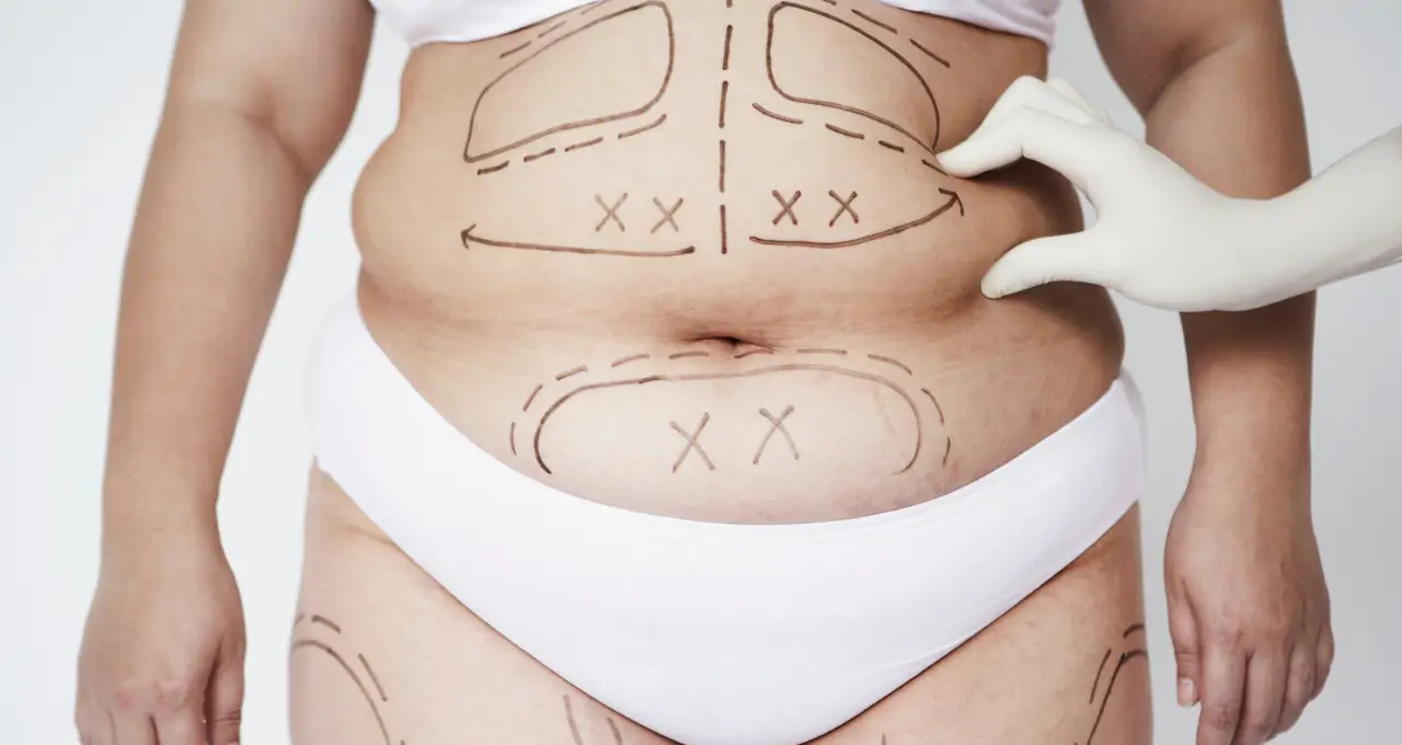 Você Sabia Que Pode Conseguir Lipoaspiração pelo Plano de Saúde? Saiba Como em 2024 2 Você Sabia Que Pode Conseguir Lipoaspiração pelo Plano de Saúde Saiba Como em 2024